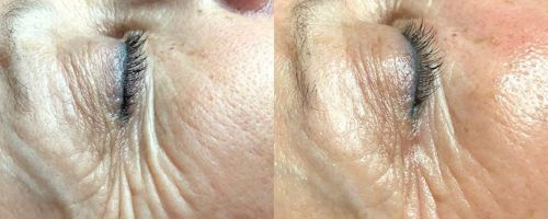 Complete Skin Revival with Hydrafacial