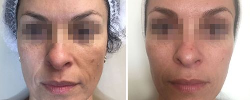 Forma RF Skin Tightening