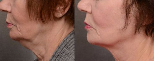 Forma RF Skin Tightening