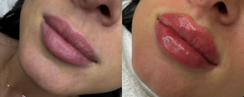 Lip augmentation