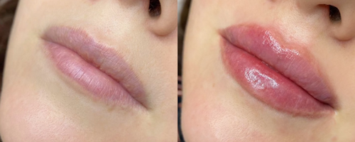 Lip augmentation