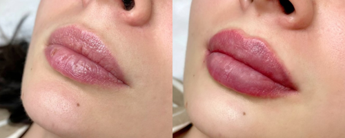 Lip augmentation