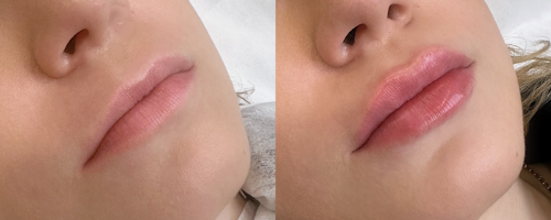 Lip augmentation