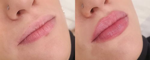 Lip augmentation