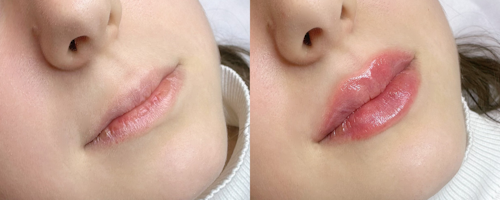 Lip augmentation