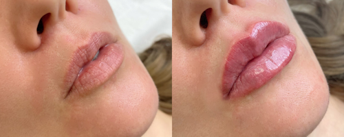 Lip augmentation