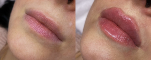 Lip augmentation