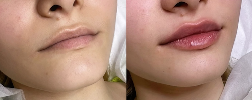 Lip augmentation