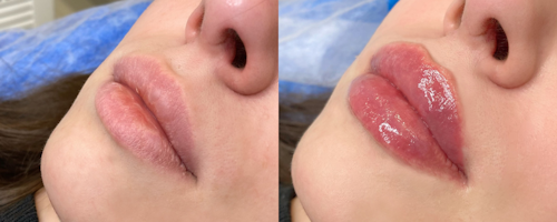 Lip augmentation