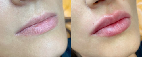 Lip augmentation