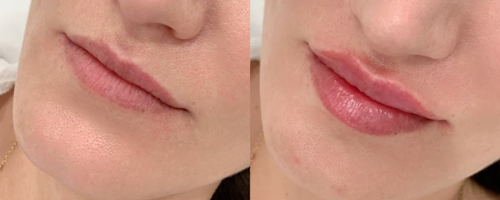 Lip augmentation