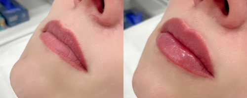 Lip augmentation