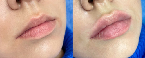 Lip augmentation