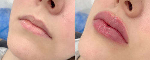 Lip augmentation