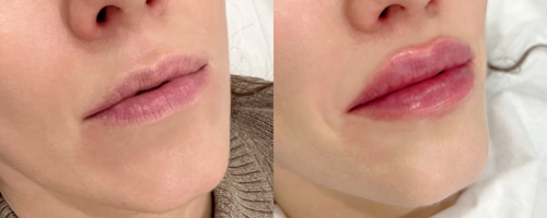 Lip augmentation