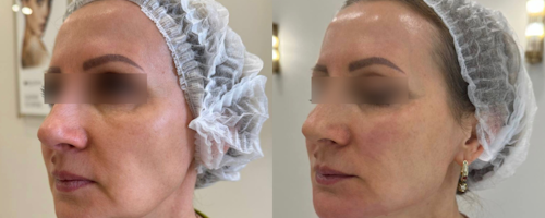 Dermal Fillers