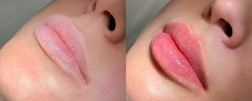 Lip augmentation