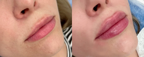 Lip augmentation