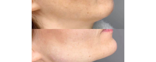 Dermal Fillers