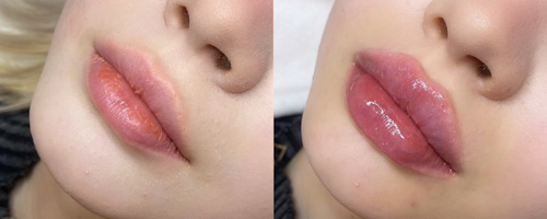 Lip augmentation